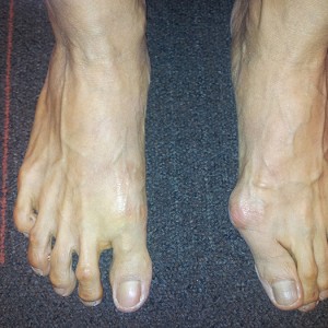 Bunion Foot Deformity