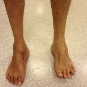 Corrected Right Hindfoot Varus Deformity (Front View)