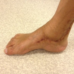 Corrected Right Hindfoot Varus Deformity (Medial View)