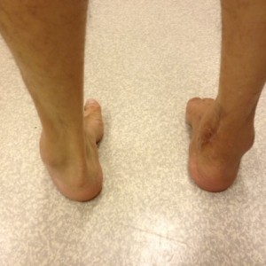 Corrected Right Hindfoot Varus Deformity (Rear View)