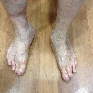 Post Op Corrected Severe Foot Deformity