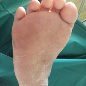 Post op corrected foot deformity - No more callosities