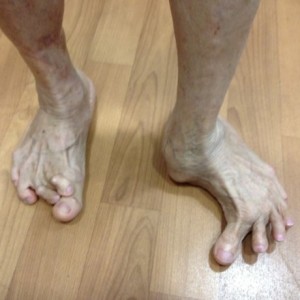 Pre Op Severe Foot Deformity