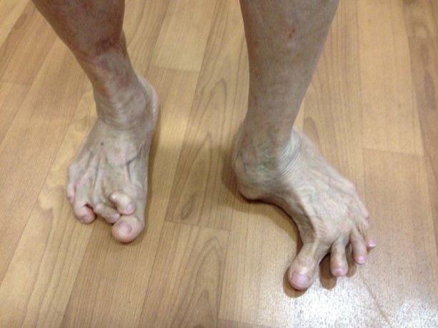 Foot Deformity Singapore Surgery Reconstruction Treatment