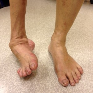 Uncorrected Right Foot Deformity