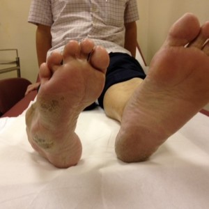Uncorrected Right Foot Deformity with Callosity on Sole