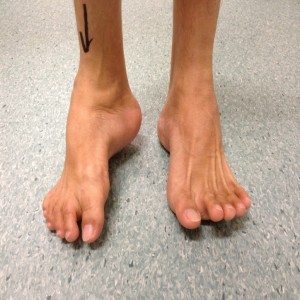 Uncorrected Right Hindfoot Varus Deformity (Front View)