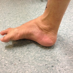 Uncorrected Right Hindfoot Varus Deformity (Medial View)