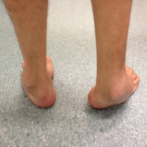 Foot Deformities Singapore|Surgery Reconstruction|Correction